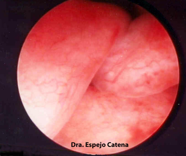  Imagen histeroscópica de pólipos endometriales