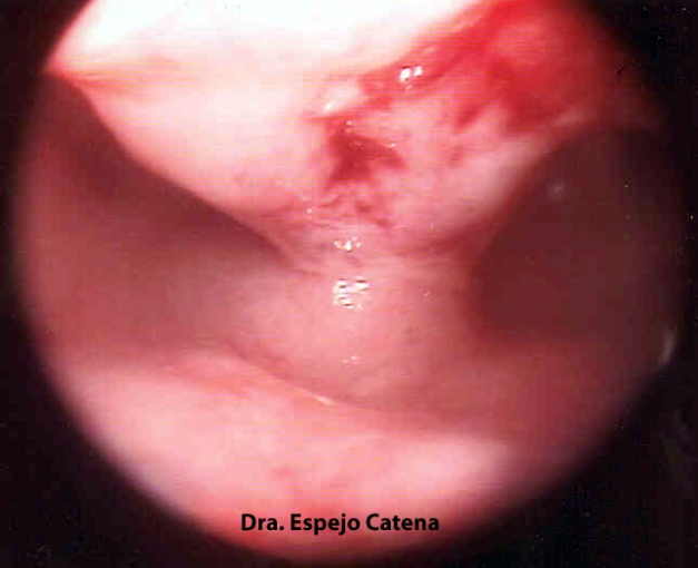 Imagen histeroscópica de un septo uterino