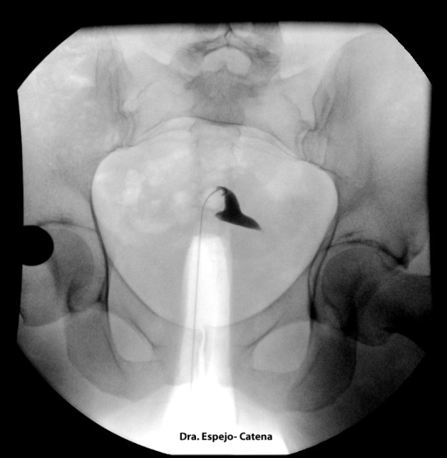 Imagen radiológica de útero durante histerosalpingografía